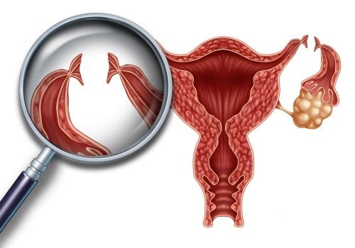 绍兴助孕：子宫囊肿如何治疗 女性必须知道的治疗方法